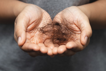 hair loss pic 